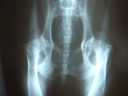 Hip dysplasia with osteoarthritis